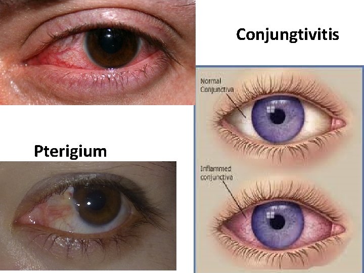 Conjungtivitis Pterigium 