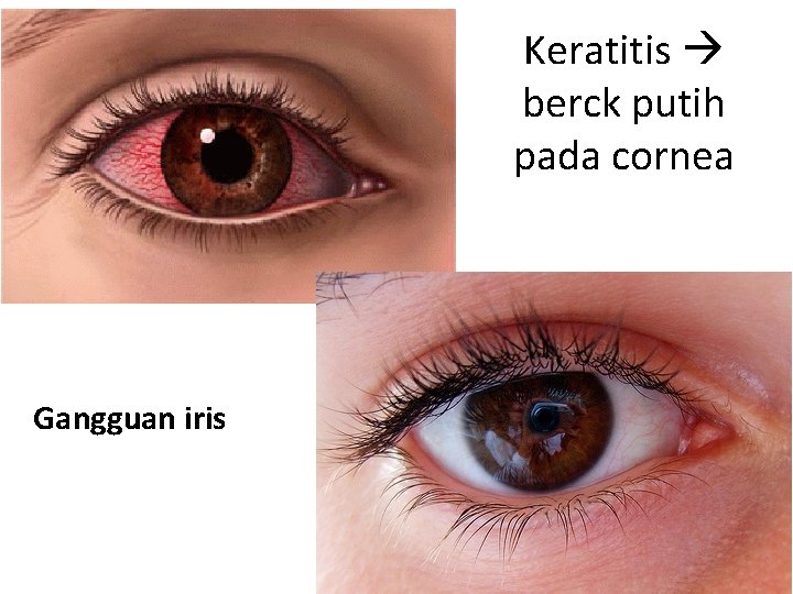 Keratitis berck putih pada cornea Gangguan iris 