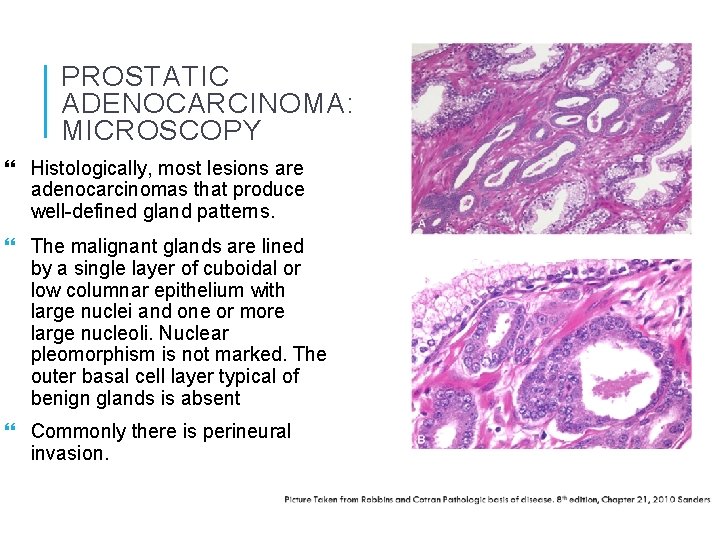 histology of prostatic adenocarcinoma)