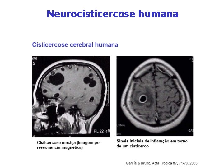 Neurocisticercose humana 