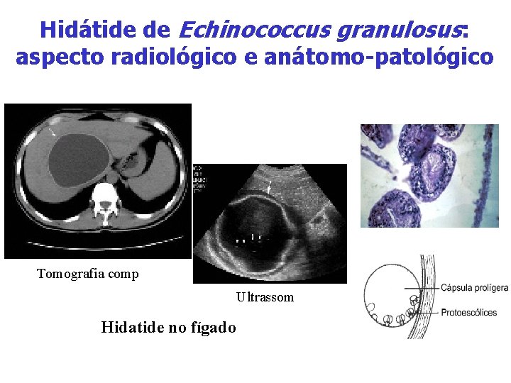 Hidátide de Echinococcus granulosus: aspecto radiológico e anátomo-patológico Tomografia comp Ultrassom Hidatide no fígado