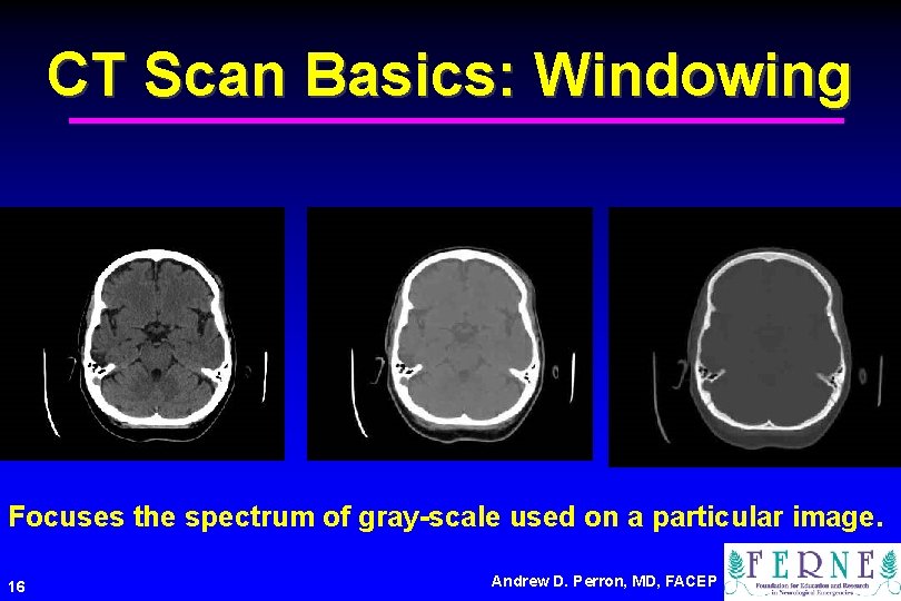 CT Scan Basics: Windowing Focuses the spectrum of gray-scale used on a particular image.