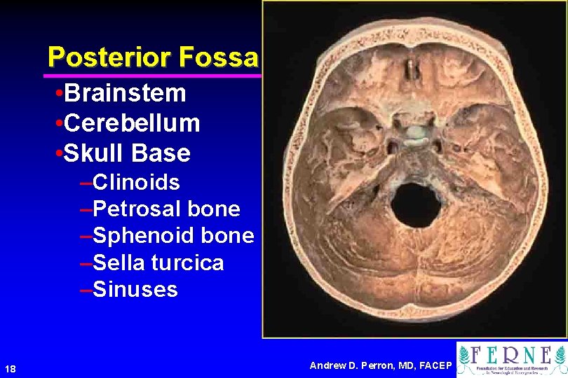 Posterior Fossa • Brainstem • Cerebellum • Skull Base –Clinoids –Petrosal bone –Sphenoid bone