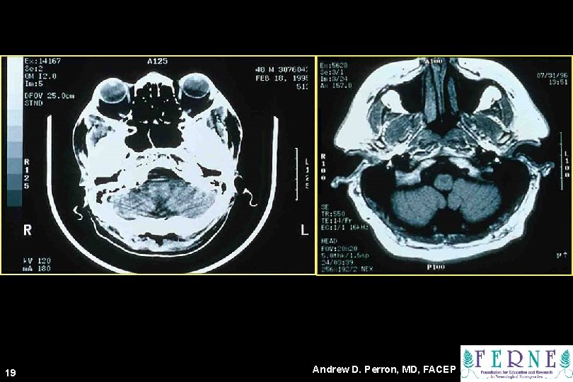 CT Scan 19 Andrew D. Perron, MD, FACEP 