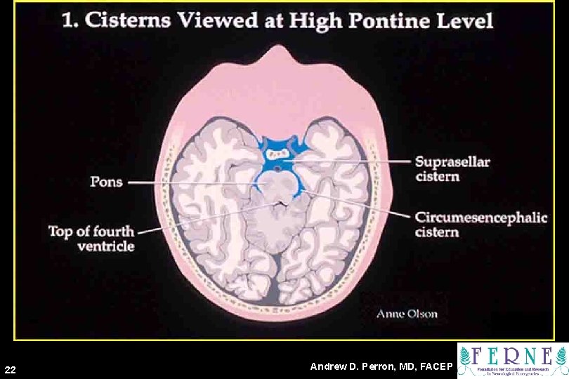 Cisterns 22 Andrew D. Perron, MD, FACEP 