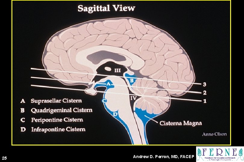 nd 2 25 2 nd Key Level Sagittal View Andrew D. Perron, MD, FACEP