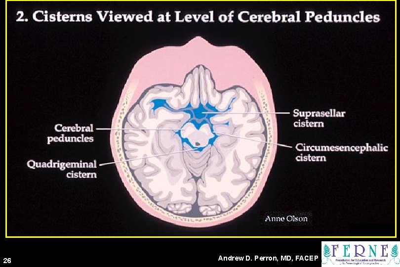 Cisterns at Cerebral Peduncles Level 26 Andrew D. Perron, MD, FACEP 