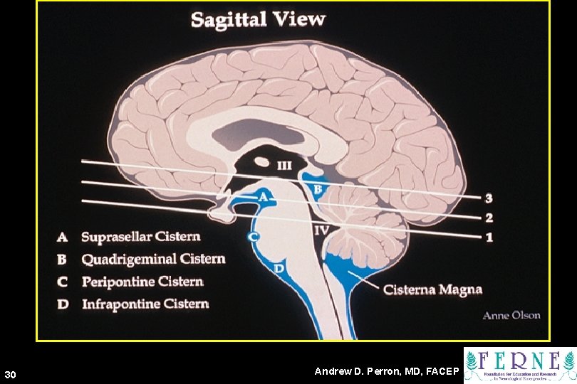 rd 3 30 Key Level Sagittal View Andrew D. Perron, MD, FACEP 