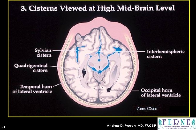 Cisterns at High Mid-Brain Level 31 Andrew D. Perron, MD, FACEP 