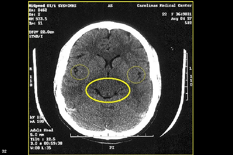 CT Scan 32 