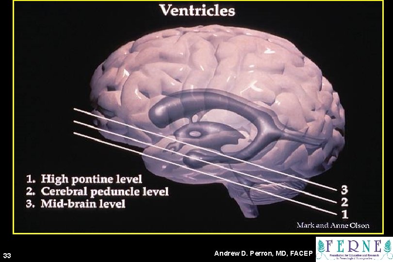 Ventricles 33 Andrew D. Perron, MD, FACEP 