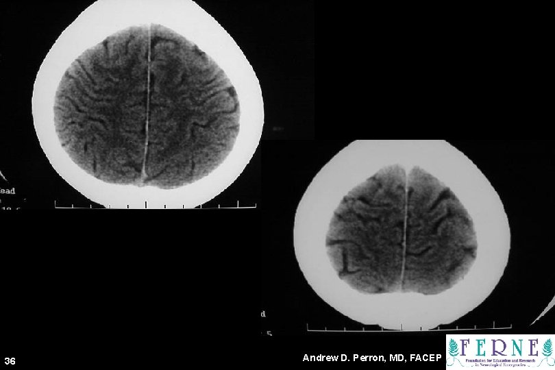 CT Scans 36 Andrew D. Perron, MD, FACEP 