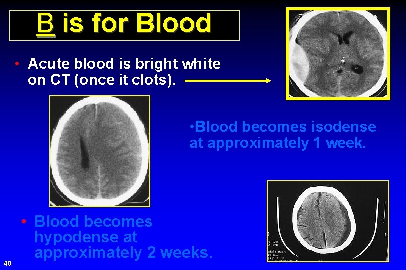 B is for Blood • Acute blood is bright white on CT (once it