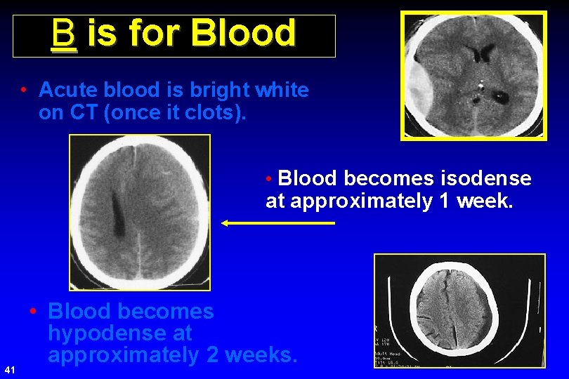 B is for Blood • Acute blood is bright white on CT (once it