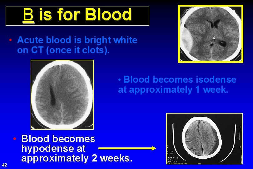 B is for Blood • Acute blood is bright white on CT (once it