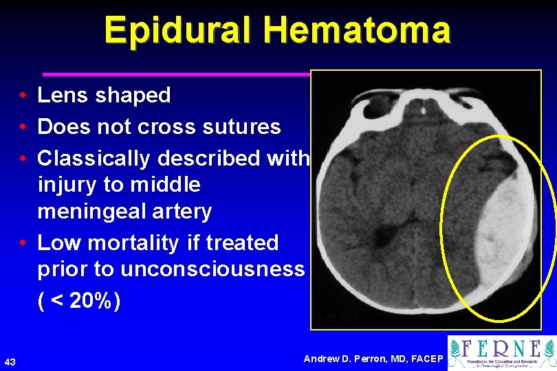 Epidural Hematoma • Lens shaped • Does not cross sutures • Classically described with