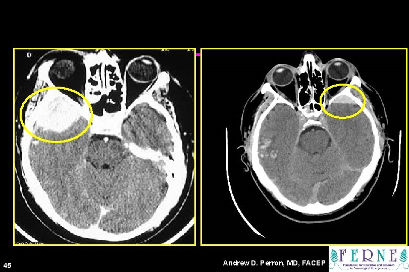 CT Scans 45 Andrew D. Perron, MD, FACEP 