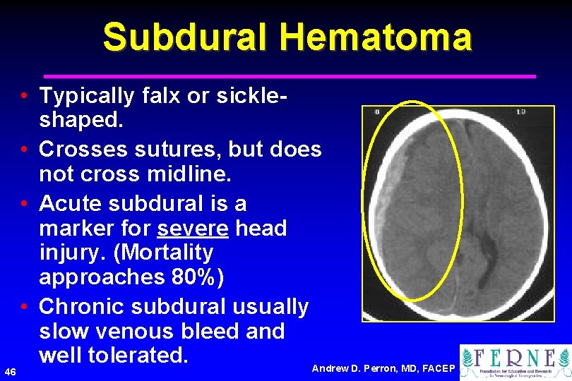 Subdural Hematoma 46 • Typically falx or sickleshaped. • Crosses sutures, but does not