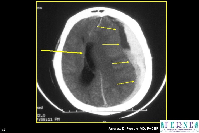 CT Scan 47 Andrew D. Perron, MD, FACEP 