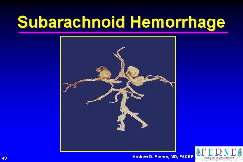 Subarachnoid Hemorrhage 49 Andrew D. Perron, MD, FACEP 