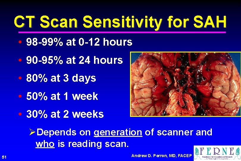 CT Scan Sensitivity for SAH • 98 -99% at 0 -12 hours • 90