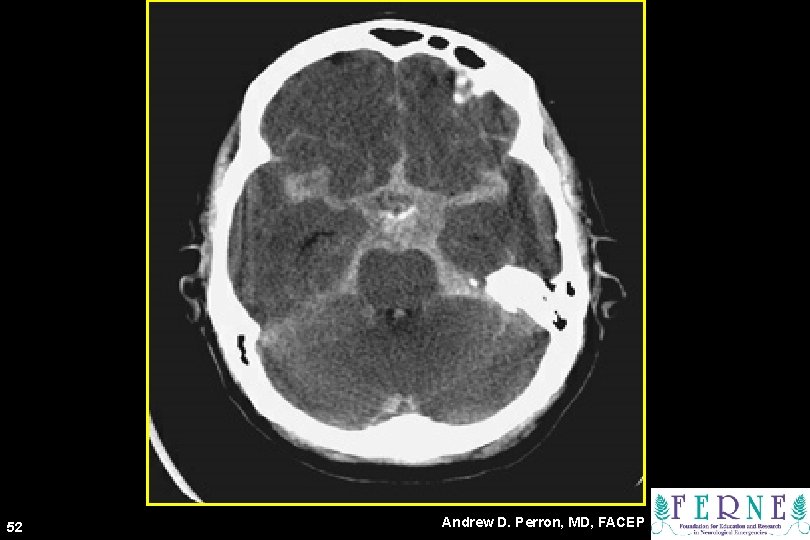 CT Scan 52 Andrew D. Perron, MD, FACEP 