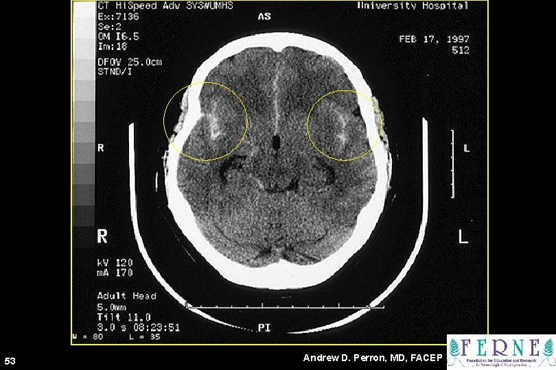 CT Scan 53 Andrew D. Perron, MD, FACEP 