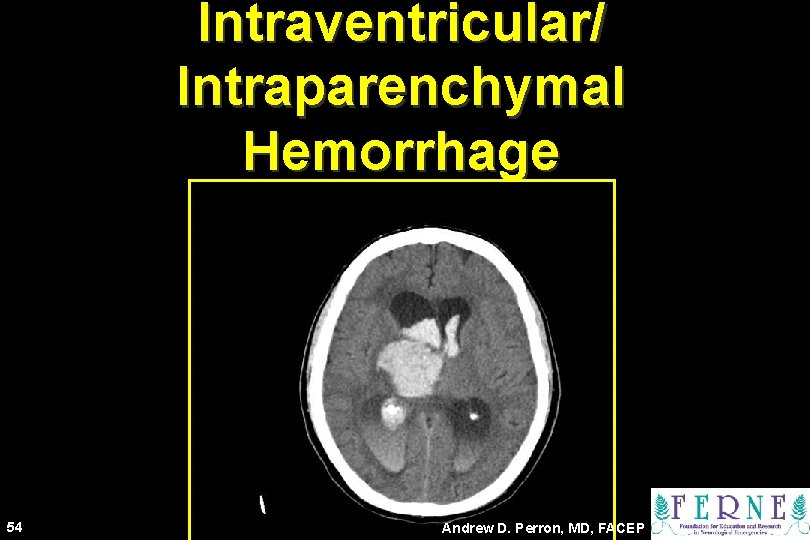 Intraventricular/ Intraparenchymal Hemorrhage 54 Andrew D. Perron, MD, FACEP 