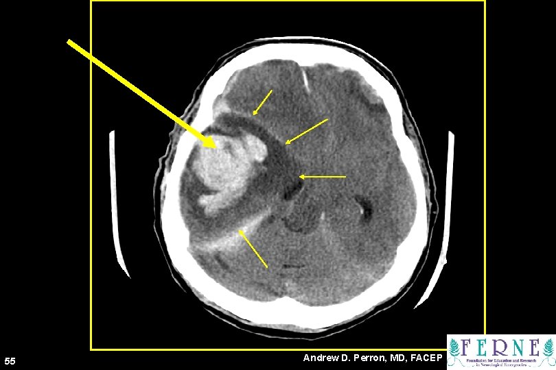 CT Scan 55 Andrew D. Perron, MD, FACEP 