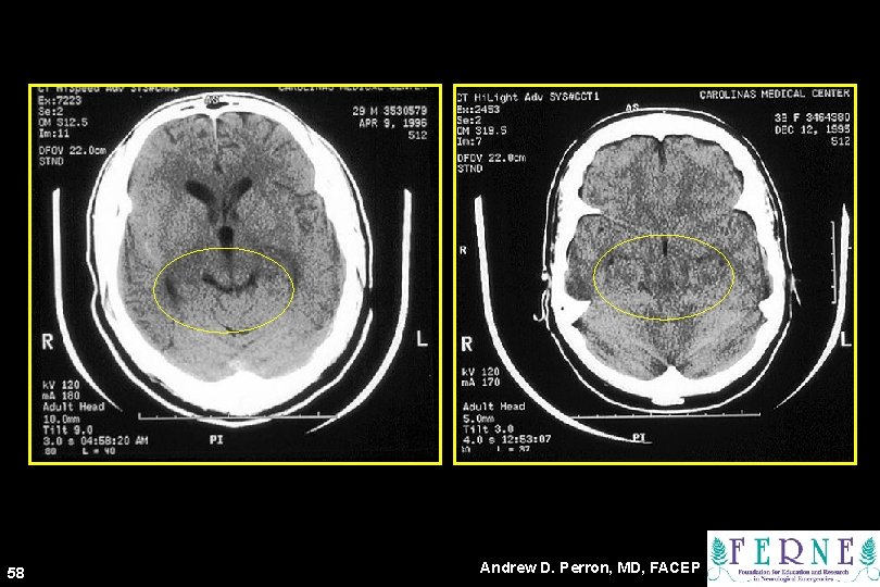 58 Andrew D. Perron, MD, FACEP 