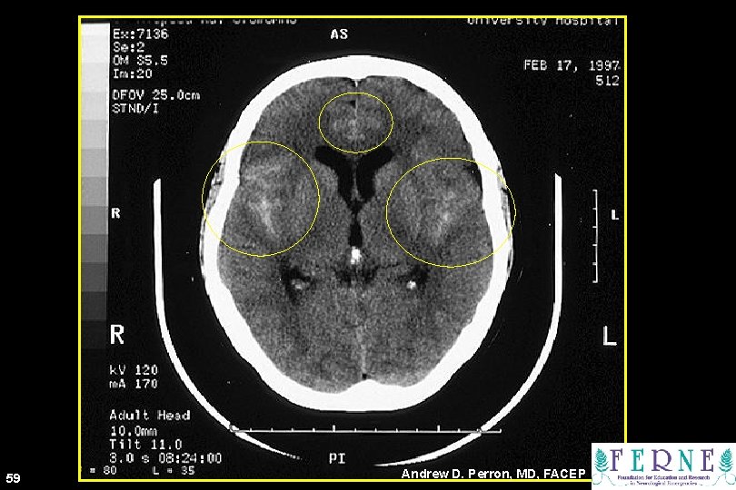 59 Andrew D. Perron, MD, FACEP 