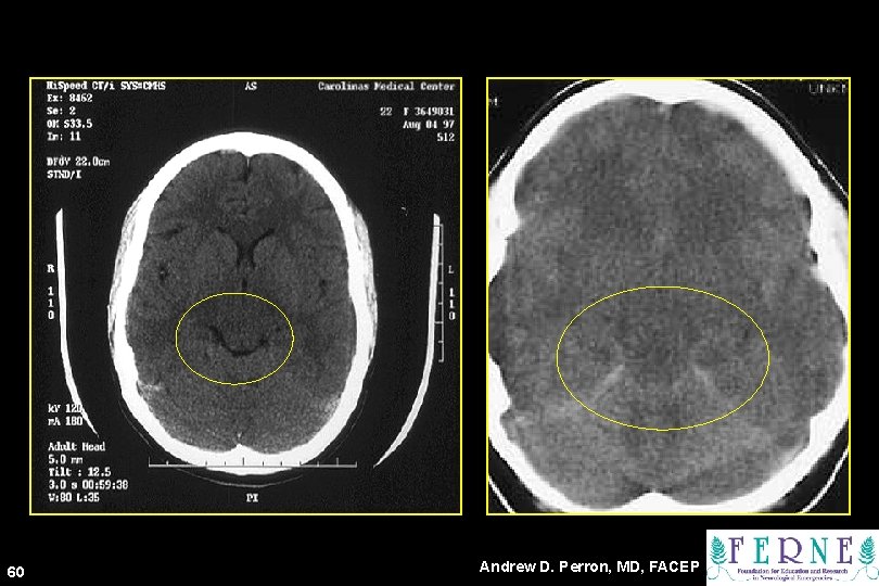 60 Andrew D. Perron, MD, FACEP 