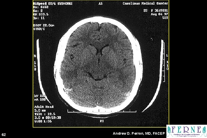 62 Andrew D. Perron, MD, FACEP 