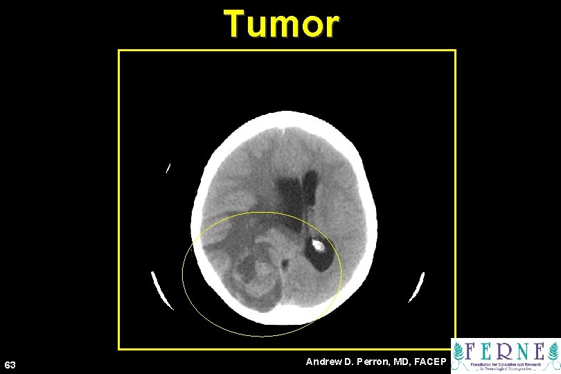 Tumor 63 Andrew D. Perron, MD, FACEP 