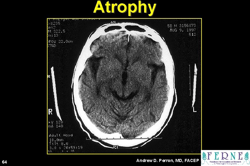 Atrophy 64 Andrew D. Perron, MD, FACEP 