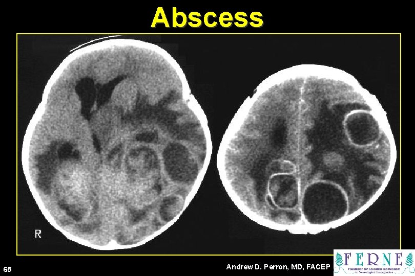 Abscess 65 Andrew D. Perron, MD, FACEP 