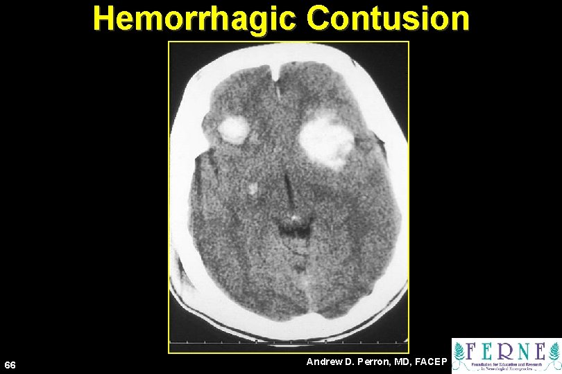 Hemorrhagic Contusion 66 Andrew D. Perron, MD, FACEP 