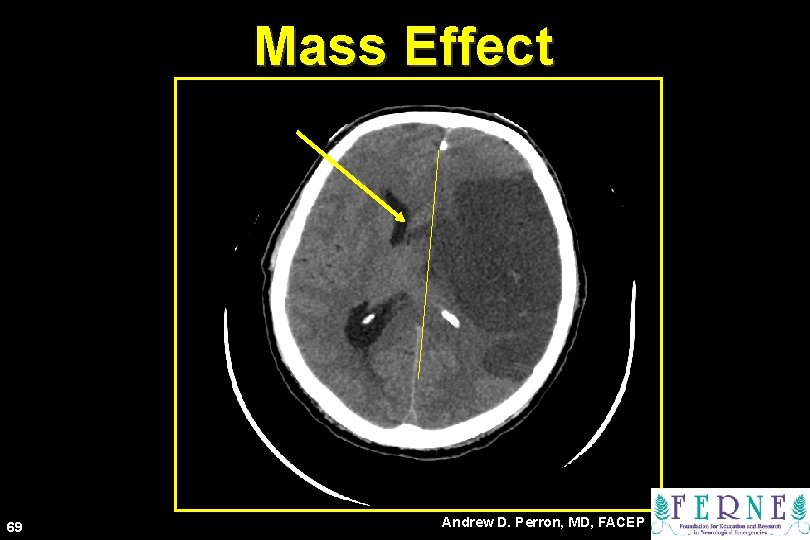 Mass Effect 69 Andrew D. Perron, MD, FACEP 