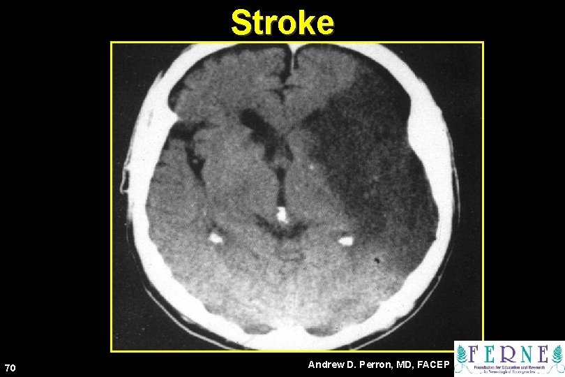 Stroke 70 Andrew D. Perron, MD, FACEP 