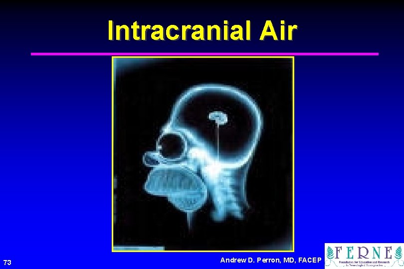 Intracranial Air 73 Andrew D. Perron, MD, FACEP 