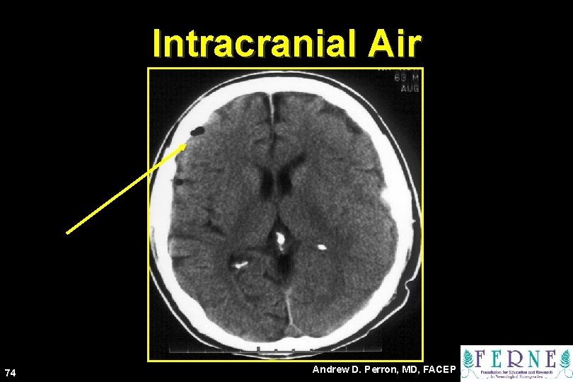 Intracranial Air 74 Andrew D. Perron, MD, FACEP 