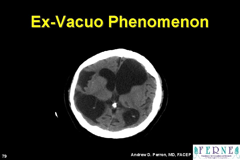 Ex-Vacuo Phenomenon 79 Andrew D. Perron, MD, FACEP 