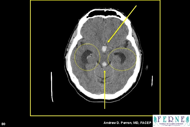 80 Andrew D. Perron, MD, FACEP 