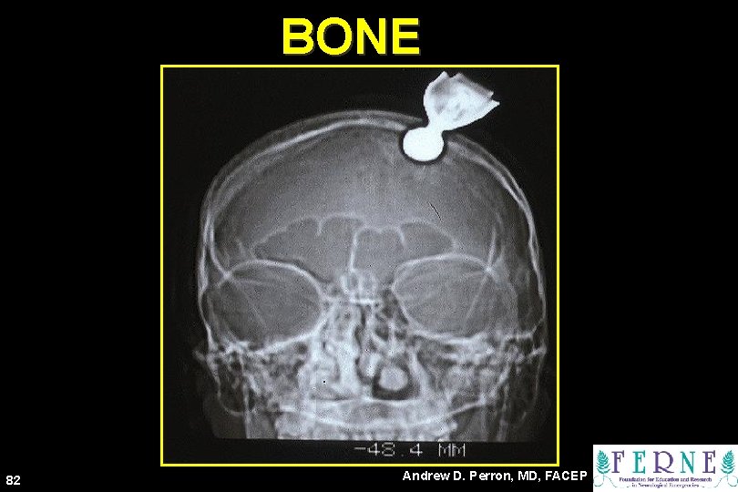 BONE 82 Andrew D. Perron, MD, FACEP 