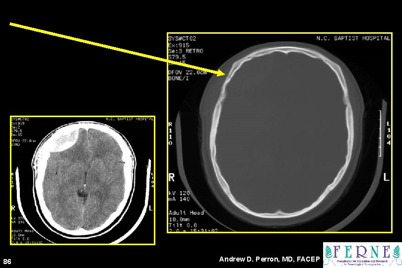 86 Andrew D. Perron, MD, FACEP 