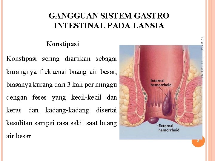 GANGGUAN SISTEM GASTRO INTESTINAL PADA LANSIA 12/7/2020 Konstipasi DOC. SATRIA Konstipasi sering diartikan sebagai