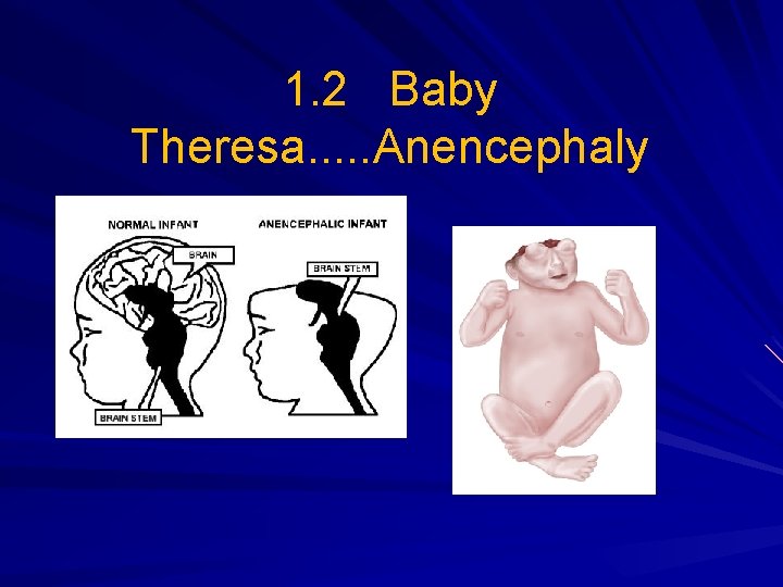 1. 2 Baby Theresa. . . Anencephaly 