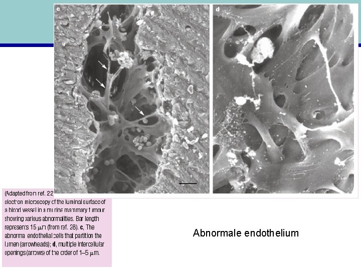 Abnormale endothelium 