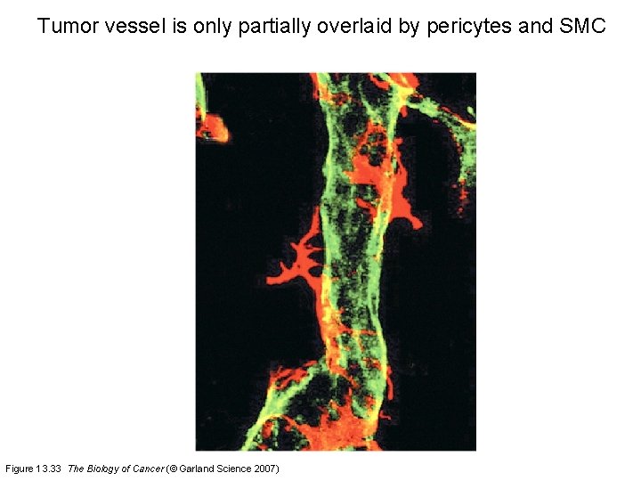 Tumor vessel is only partially overlaid by pericytes and SMC Figure 13. 33 The