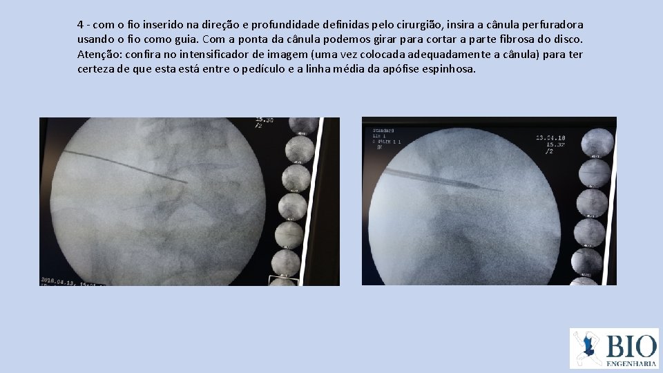 4 - com o fio inserido na direção e profundidade definidas pelo cirurgião, insira